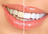 SmileWhite™ Teeth Whitening Pen